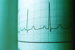 EKG ritim kaydı