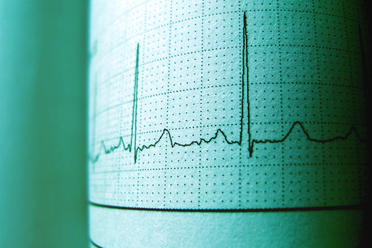EKG ritim kaydı