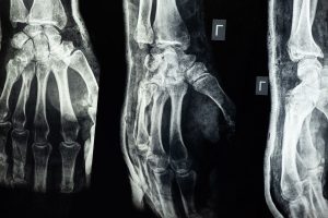 Glukokortikoid Kaynaklı Osteoporoz: Kronik Stres Kemiği Nasıl Eritir? El röntgeni, kemik yapısı